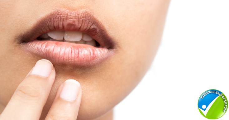 what causes chronic dry chapped lips