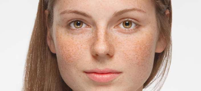 Know the Causes, Symptoms, and Treatments of Hyperpigmentation