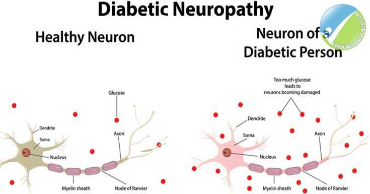 Causes and Risk Factors Of Neuropathy