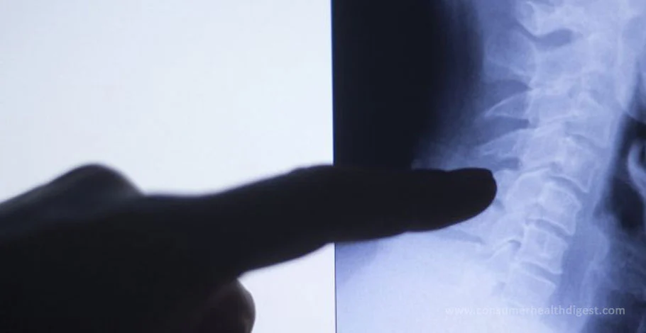 Arthritis on X-Ray: Diagnosing Arthritis with X-Ray