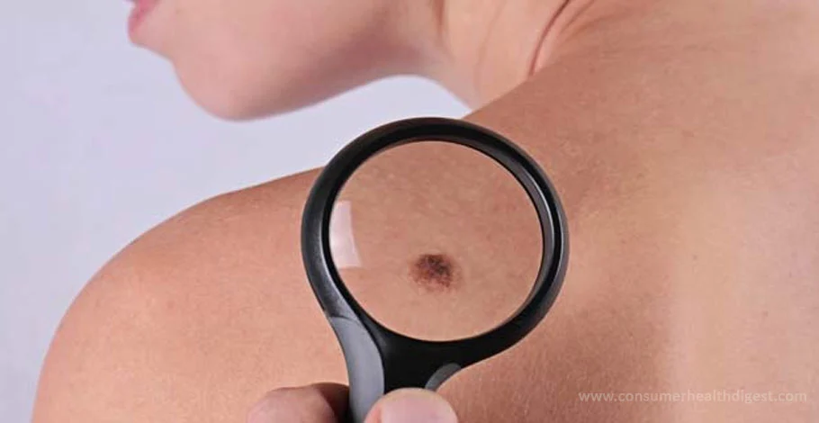 Is There a Reason to be Scared If you Notice Atypical Mole?