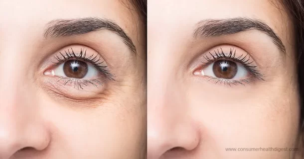Understanding the Science Behind Under Eye Puffiness