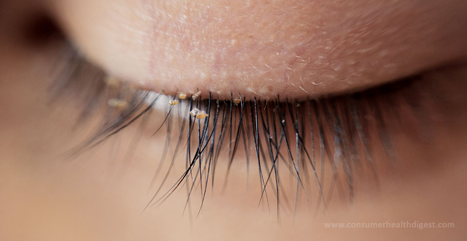 What Are Eyelash Mites How Do They Occur And How To Vanish Them 