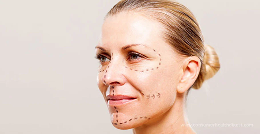 Face Lift – What to Expect from this Surgery?