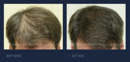 Foligrowth Before and After Men