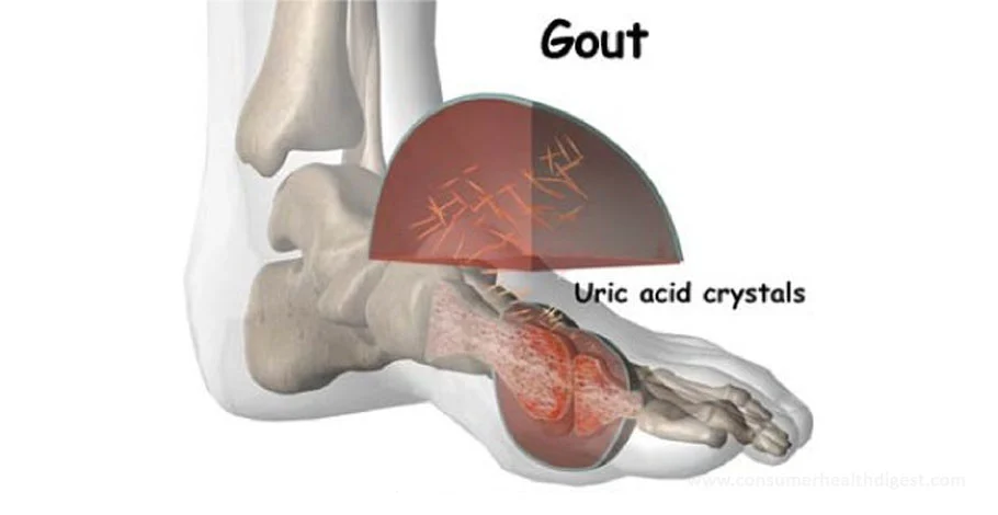 Gout and Gall Bladder Disease – What You Really Need to Know