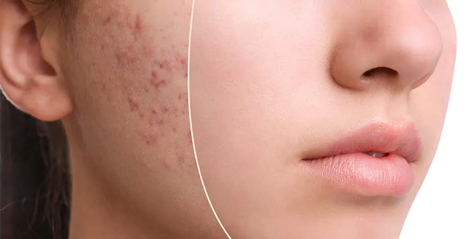 How to Get Rid of Acne – Treatments and Home Remedies