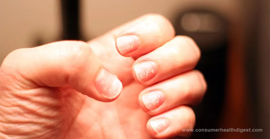 Menopause and Brittle Nails: Characteristics, Symptoms, Remedies and More