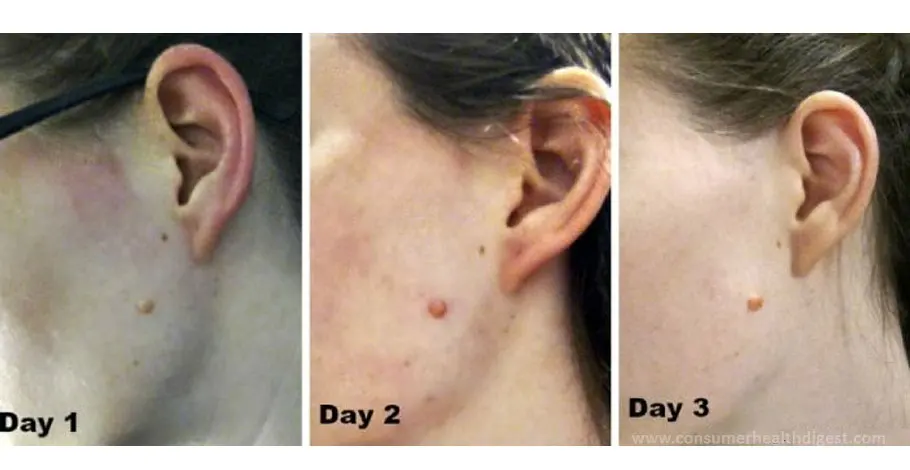 My Experience With Natural Mole Removal – Getting Rid of Moles Naturally