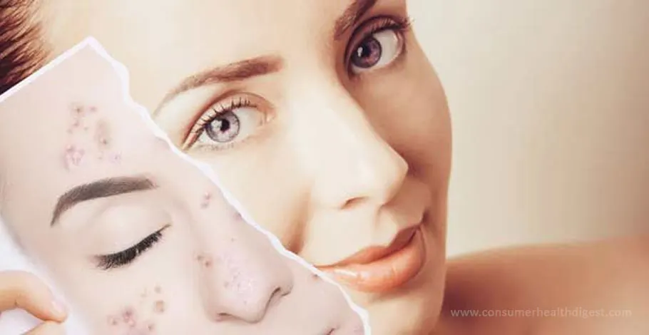 Pigmentation: The Best Treatment For Skin Pigmentation
