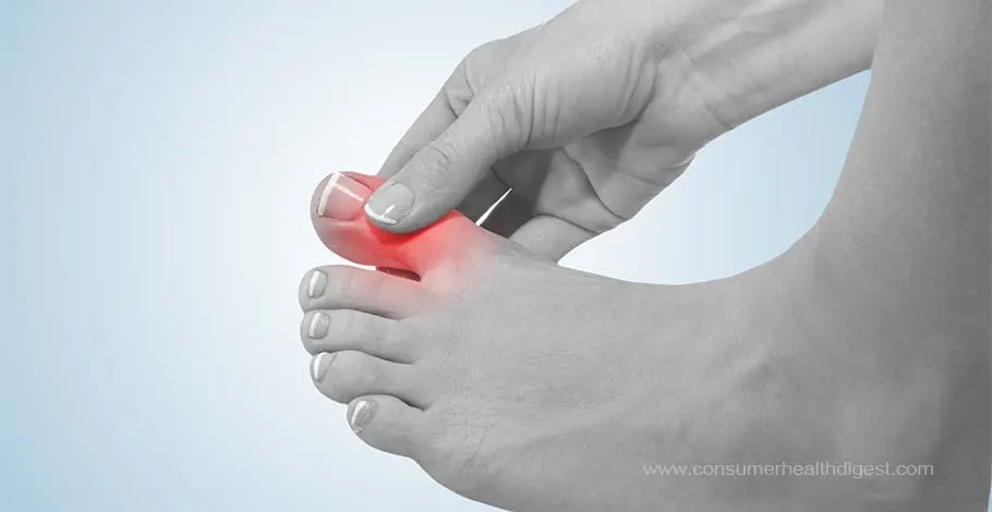 What Can You Do to Help Prevent and Manage Gout?